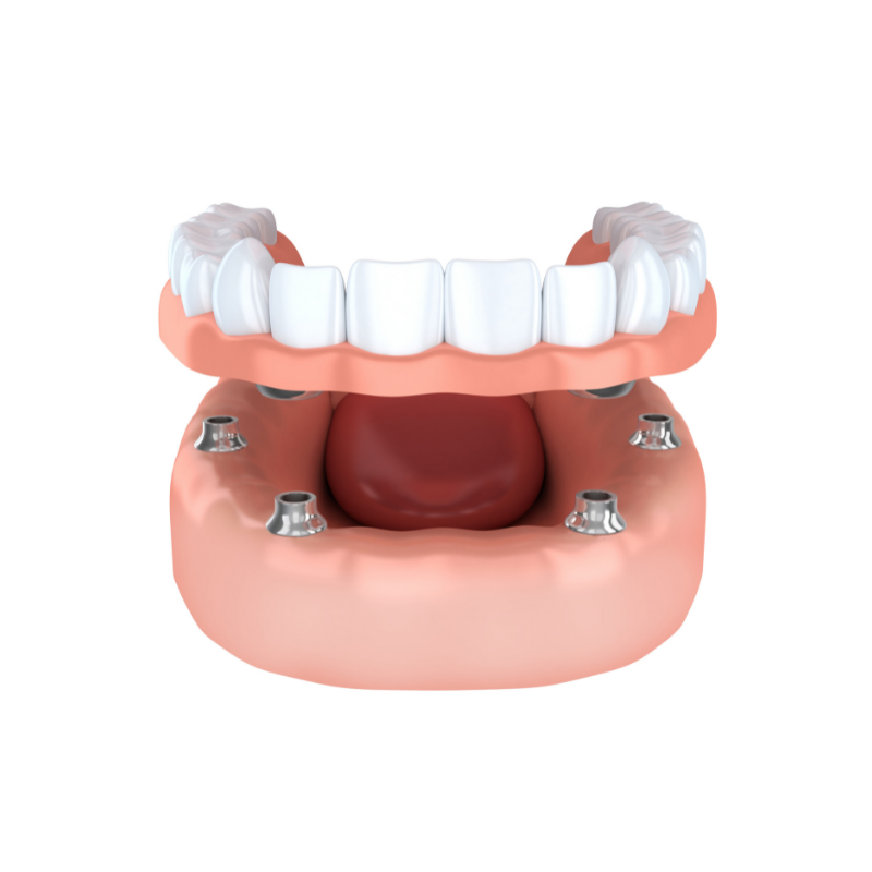 dental_implants_Washington