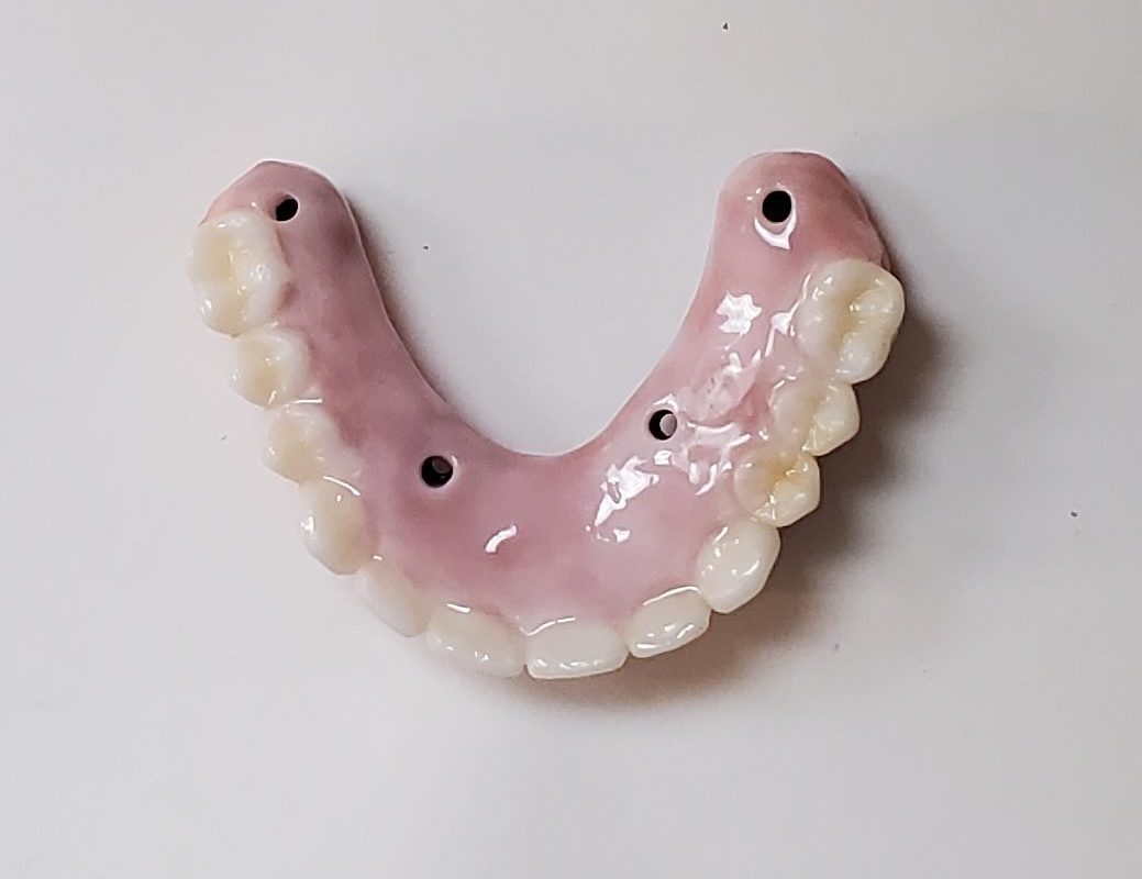 dental_implants_Everett_WA