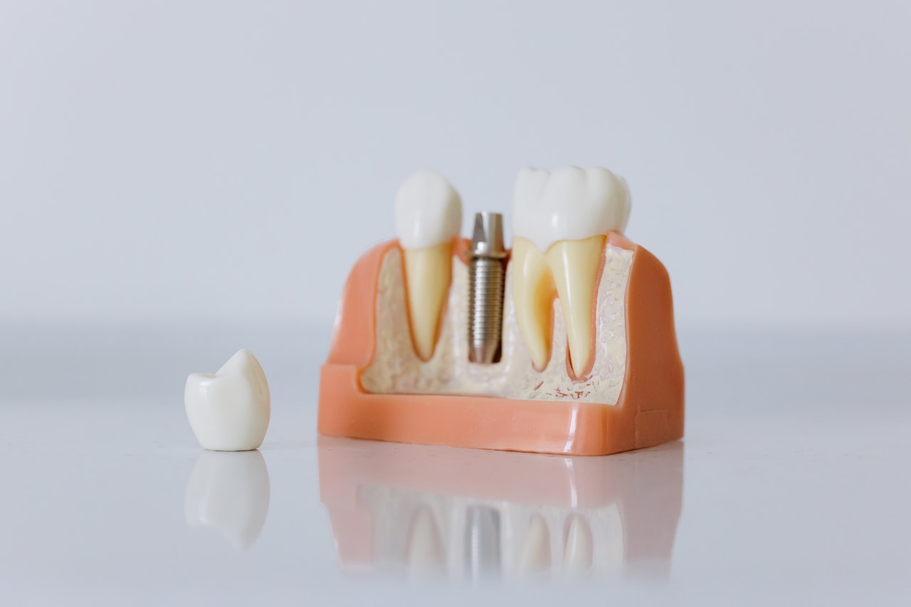 dental_implants_Everett_implant_dentist